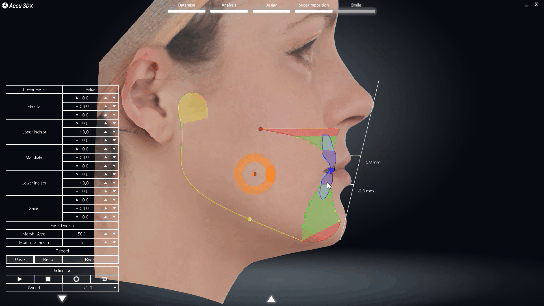 Traceline for Orthodontic Treatment